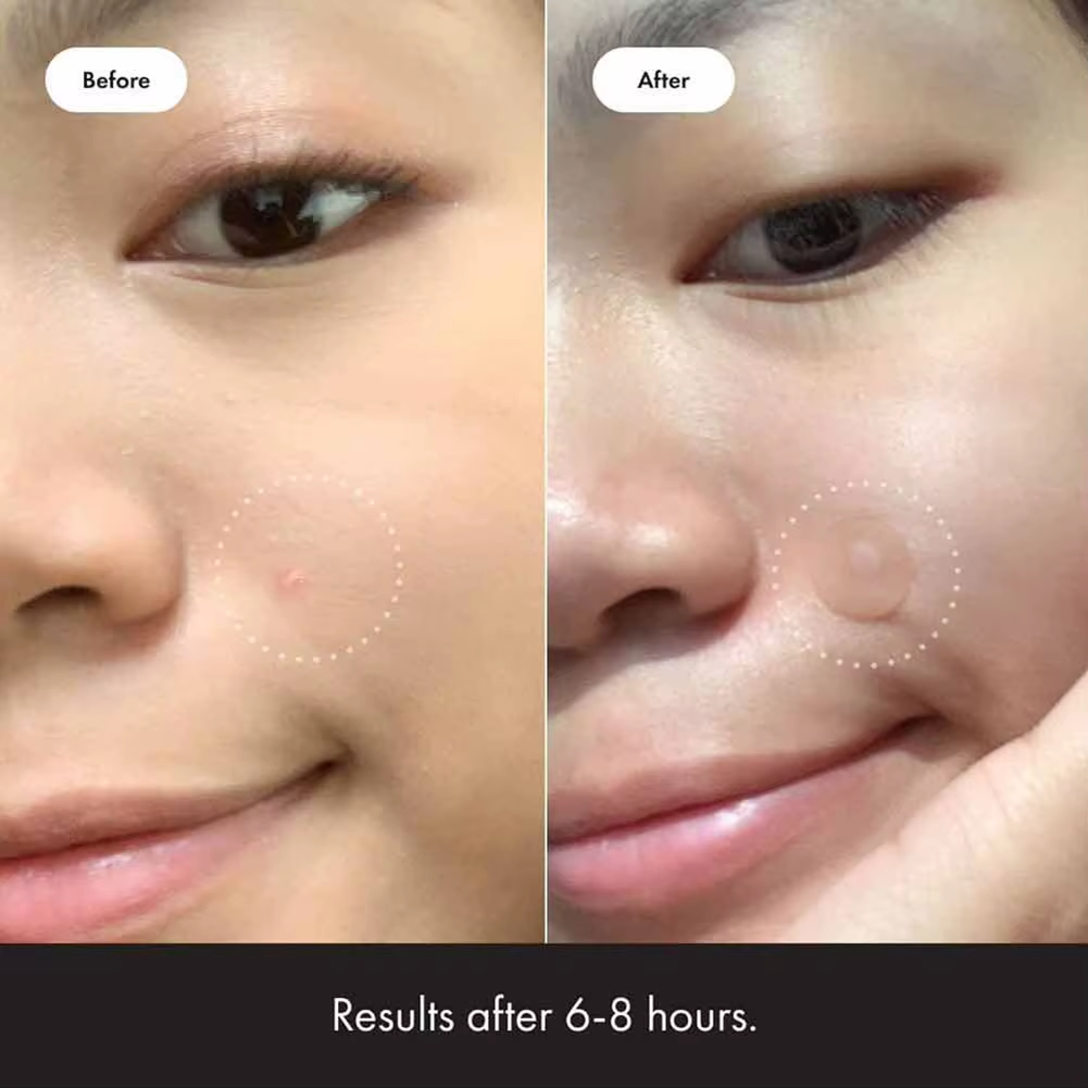 Hydrogel Acne Patch Invisible Closed Mouth Invisible Acne Face Invisible Waterproof and Breathable Skin Patch Skin Care Tools