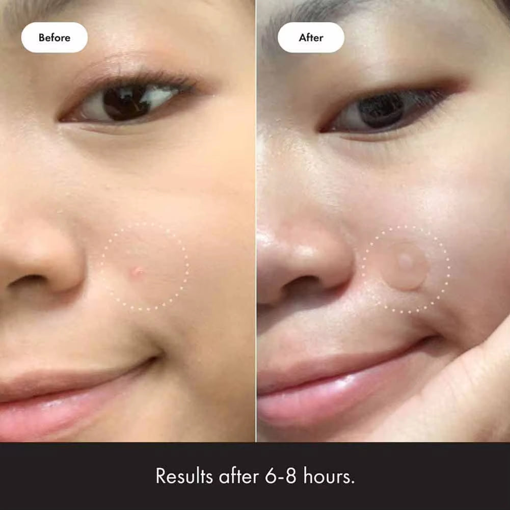 Hydrogel Acne Patch Invisible Closed Mouth Invisible Acne Face Invisible Waterproof and Breathable Skin Patch Skin Care Tools